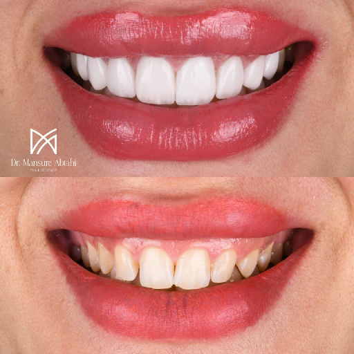 لمینیت سرامیکی در اصفهان دکتر منصوره سادات ابطحی