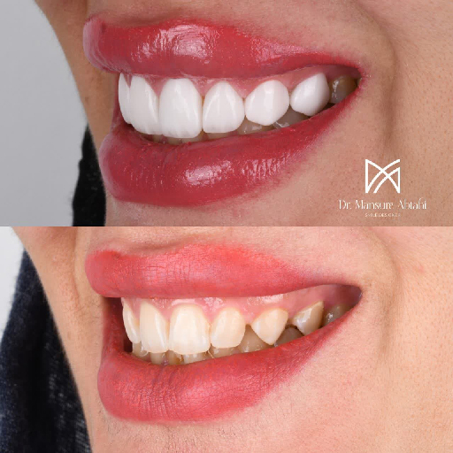 لمینیت سرامیکی در اصفهان دکتر منصوره سادات ابطحی