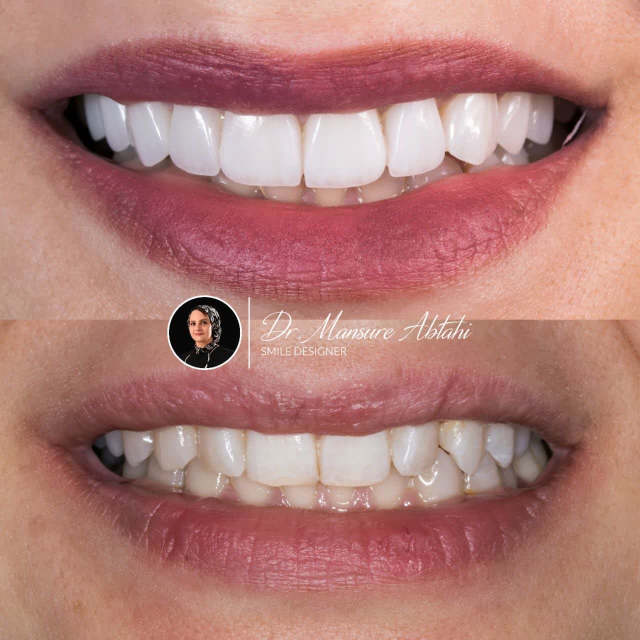 لمینیت سرامیکی در اصفهان دکتر منصوره سادات ابطحی