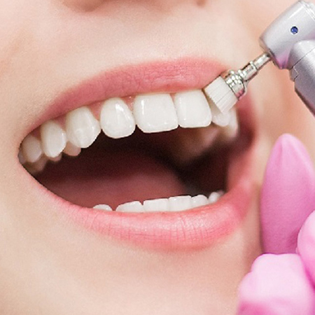 پالیش کامپوزیت دندان