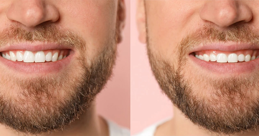 همه چیز درباره لیفت لثه | دکتر منصوره سادات ابطحی