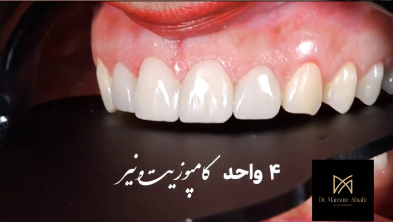 یک تغییر بزرگ تنها با چهار واحد کامپوزیت ونیر | دکتر منصوره سادات ابطحی