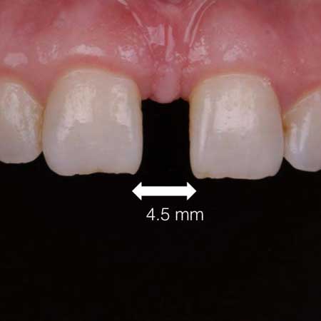 پر كردن فاصله بين دندانها با کامپوزیت
