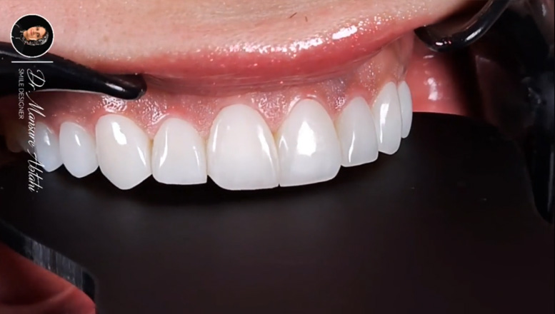 کامپوزیت ونیر طبیعی در اصفهان | دکتر منصوره سادات ابطحی، متخصص دندانپزشکی ترمیمی و زیبایی اصفهان