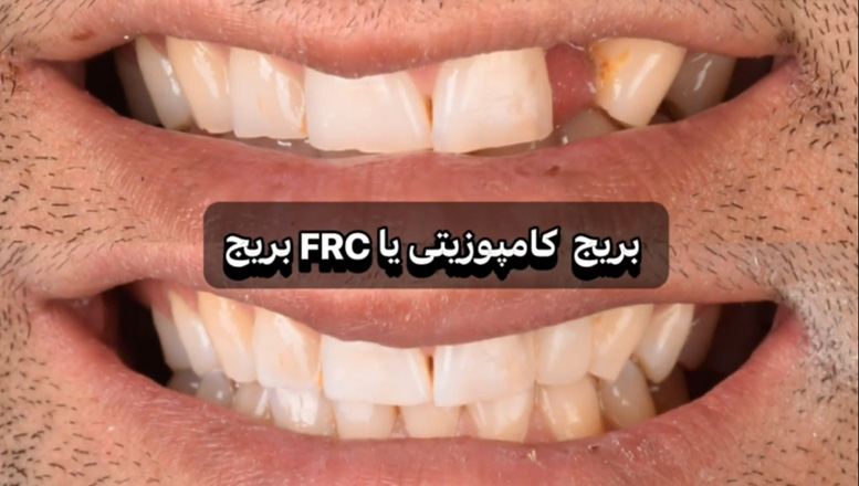 بریج یک جلسه ای یا کامپوزیتی تقویت شده با فایبر چیست؟ | دکتر منصوره سادات ابطحی در اصفهان