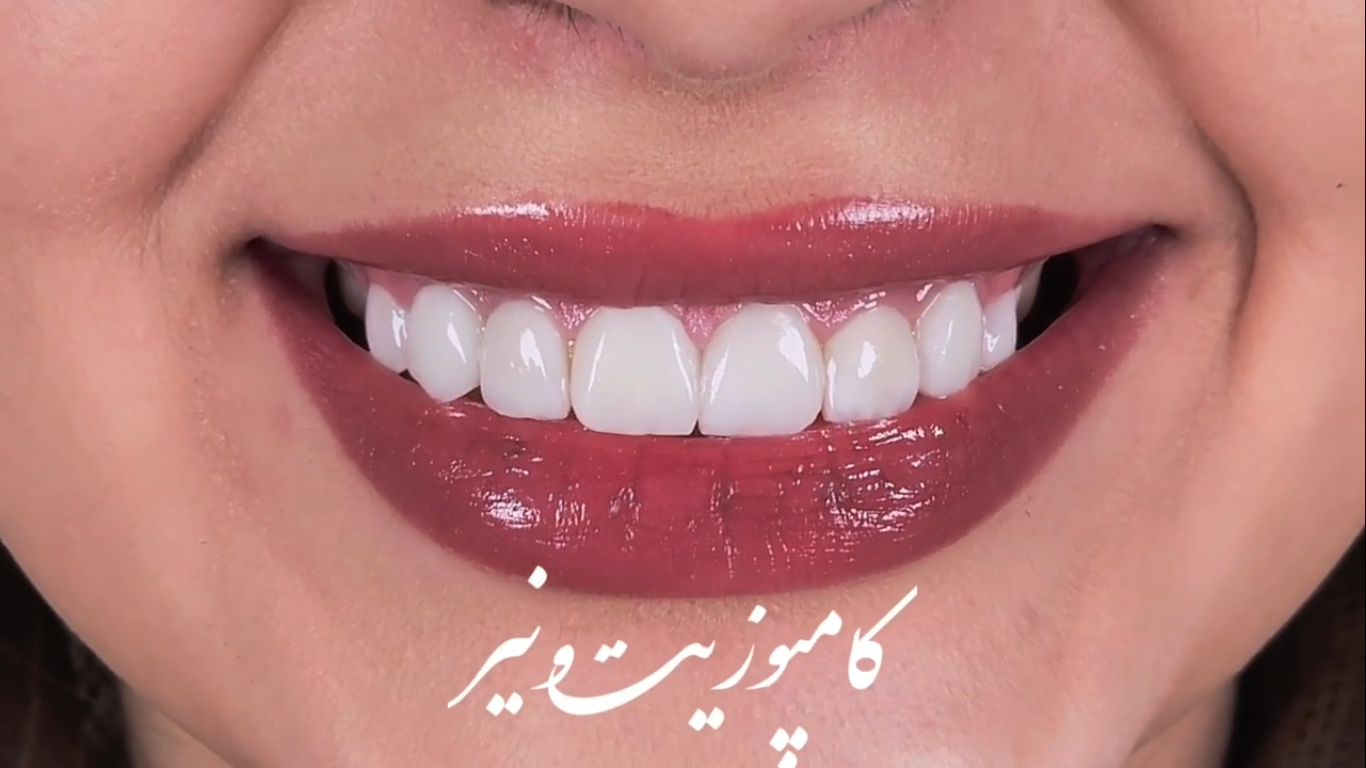 ۸ واحد کامپوزیت ونیر به منظور اصلاح فرم دندانها | دکتر منصوره سادات ابطحی