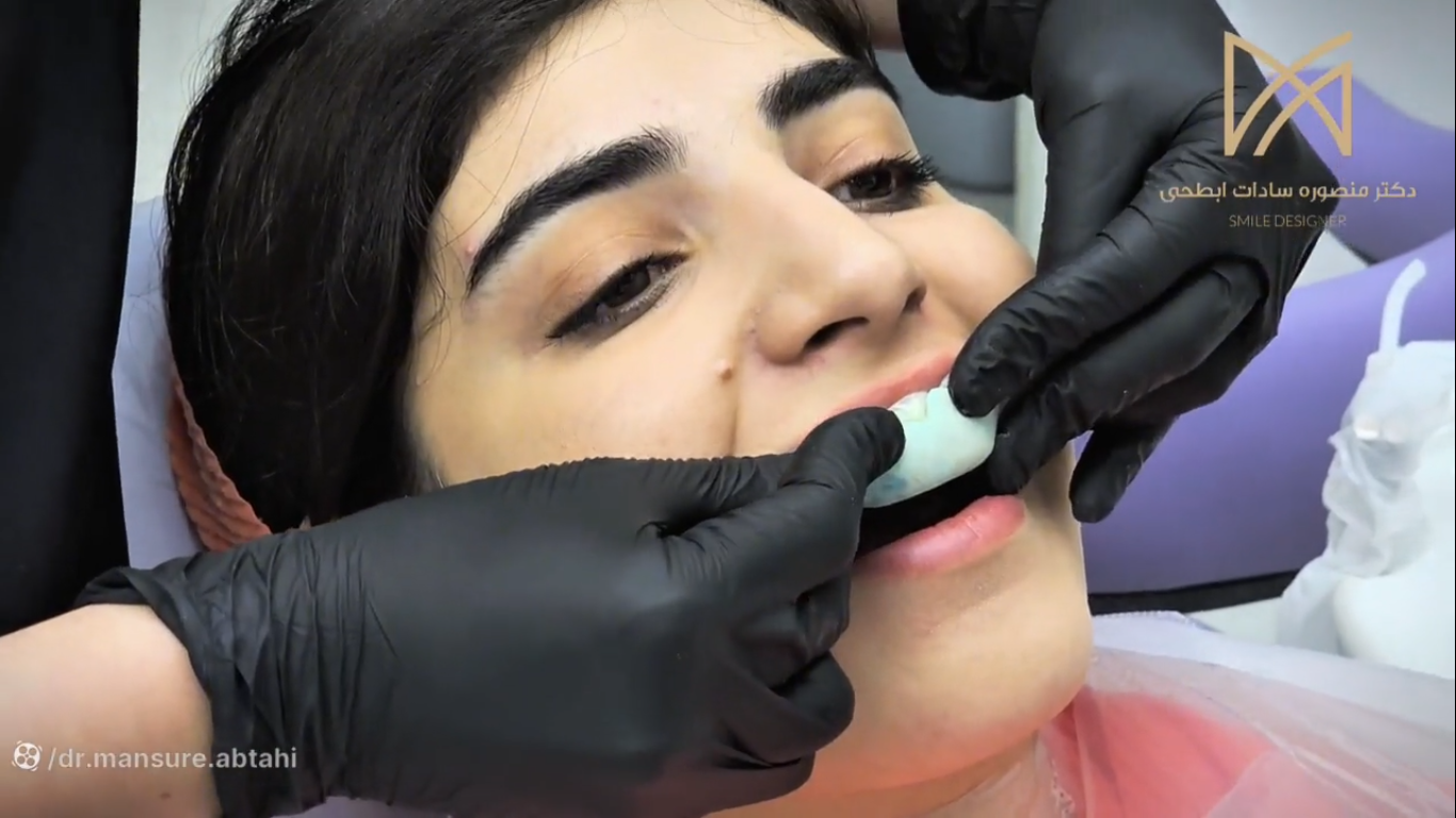 طراحی لبخند دیجیتال چیست؟ | دکتر منصوره سادات ابطحی