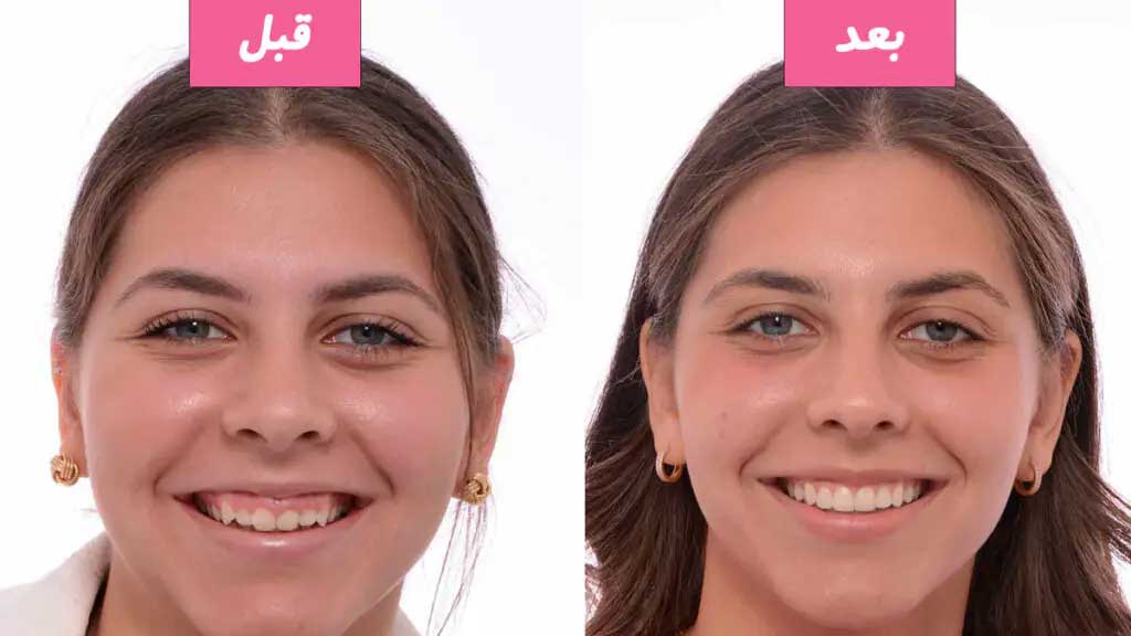اصلاح لبخند لثه ای چگونه است؟