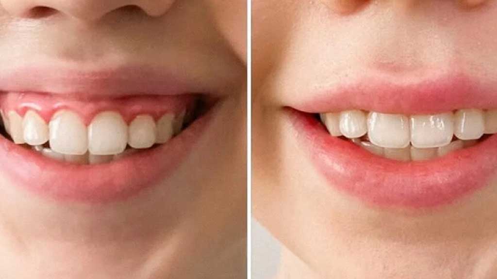 درمان لبخند لثه ای