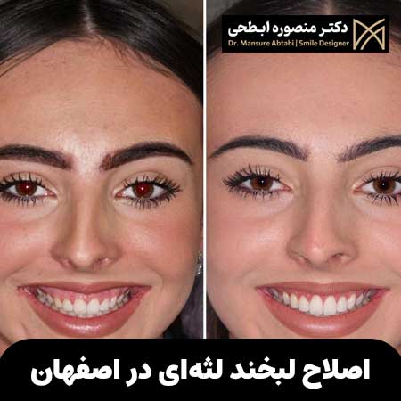 روش اصلاح لبخند لثه‌ای اصفهان
