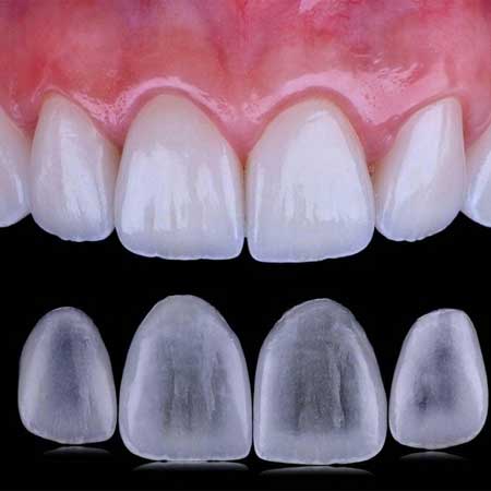 کامپوزیت ای پی اس (IPS) در اصفهان