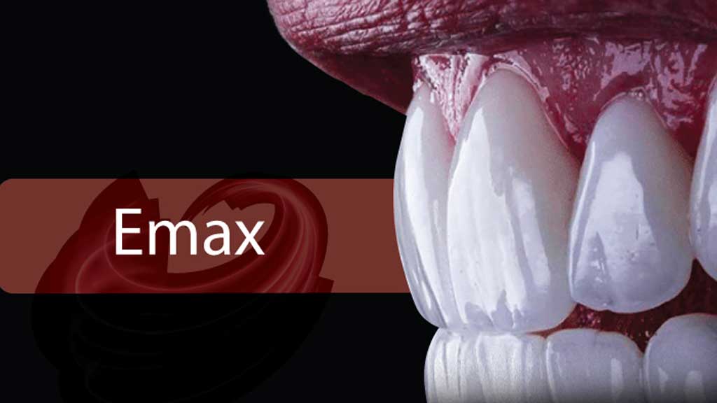 انواع لمینت ایمکس در کلینیک های دندانپزشکی اصفهان