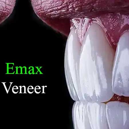 لمینت سرامیکی ایمکس در اصفهان