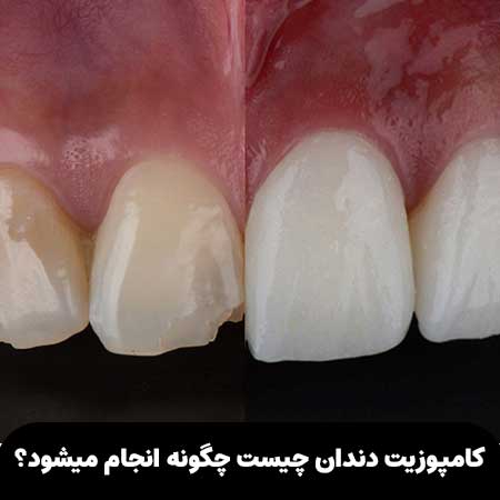 What-is-dental-composite-and-how-is-it-done