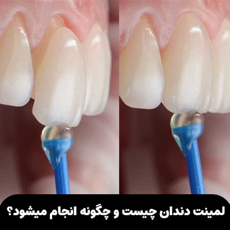 لمینت دندان چیست و چگونه انجام میشود؟