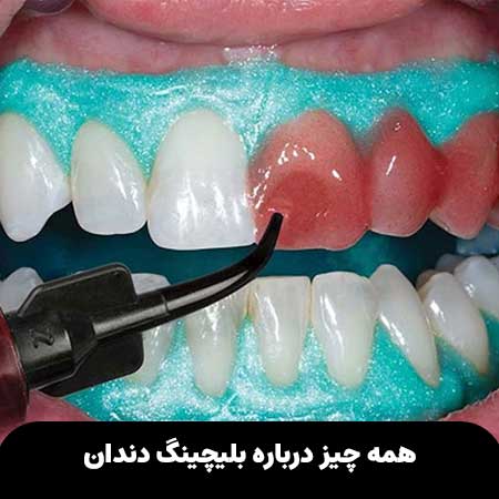 همه چیز درباره بلیچینگ دندان