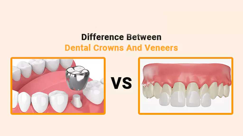 کامپوزیت بهتر است یا روکش دندان؟