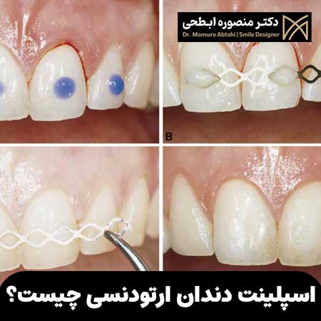 اسپلینت دندان ارتودنسی چیست؟