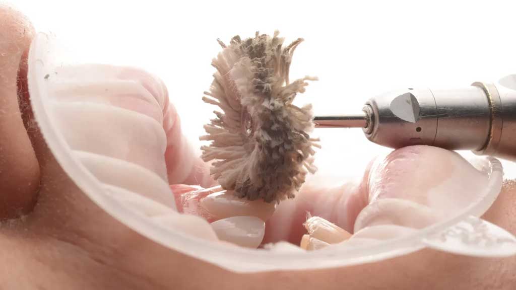 پالیش کامپوزیت هر چند وقت یکبار؟