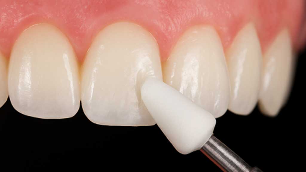 پولیش دندان بعد از کامپوزیت چیست؟