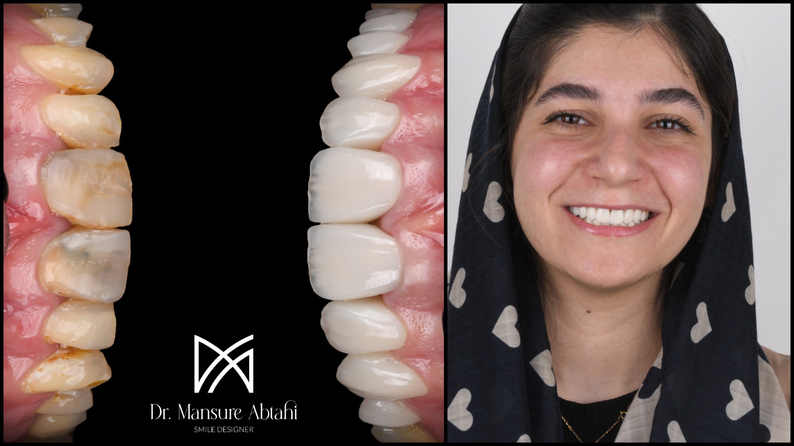 لمینت سرامیکی دندان بیمار عزیز از چهارباغ بالا اصفهان