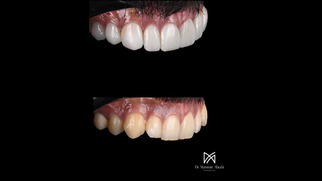 درمان لمینیت سرامیکی مراجعه کننده عزیز از مرداویج اصفهان | دکتر منصوزه ابطحی