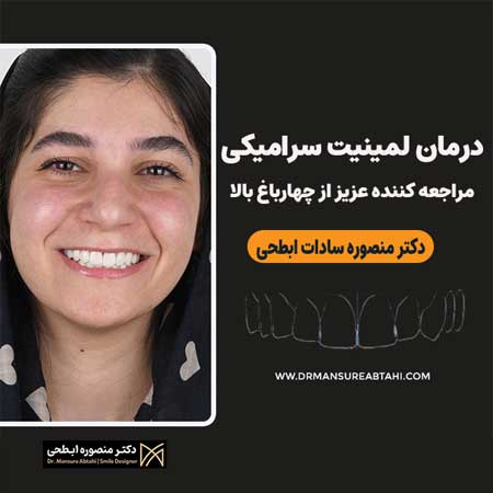 لمینت سرامیکی دندان بیمار عزیز از چهارباغ بالا اصفهان