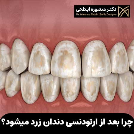 چرا بعد از ارتودنسی دندان زرد میشود؟