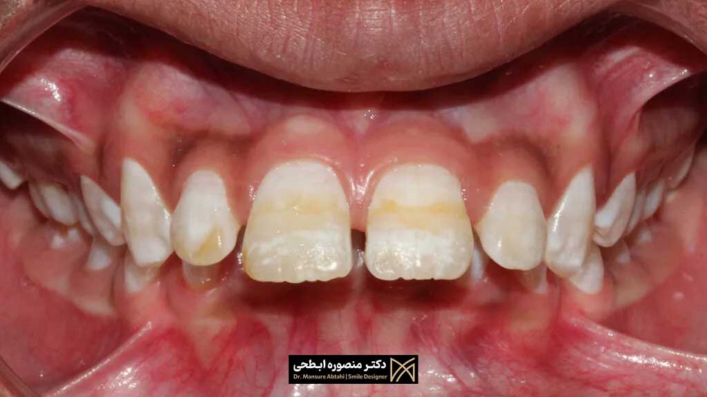 زرد شدن دندان بعد از ارتودنسی