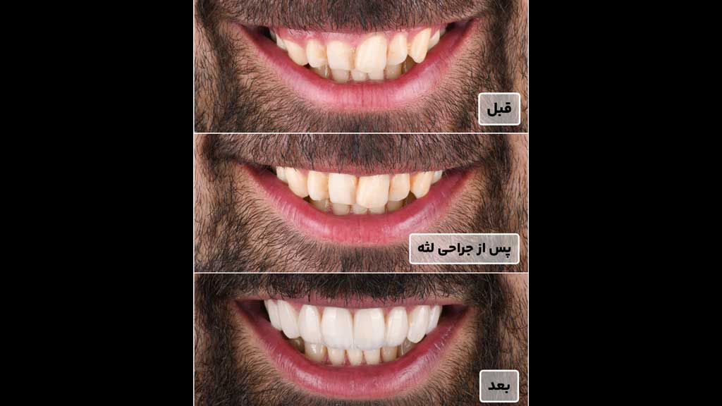 لمینت دندان برای مراجعه کننده عزیز از بهارستان توسط دکتر منصوره ابطحی