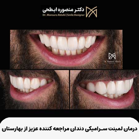 درمان لمینت سرامیکی دندان مراجعه کننده عزیز از بهارستان در مطب دکتر منصوره ابطحی