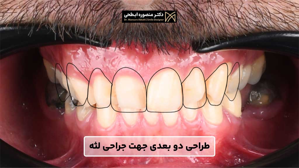  لمینت دندان و طراحی لبخند دوبعدی جهت جراحی لثه مراجعه کننده عزیز از بهارستان توسط دکتر منصوره ابطحی