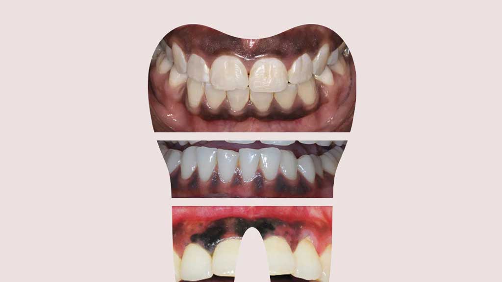 چگونه سیاهی لثه را از بین ببریم