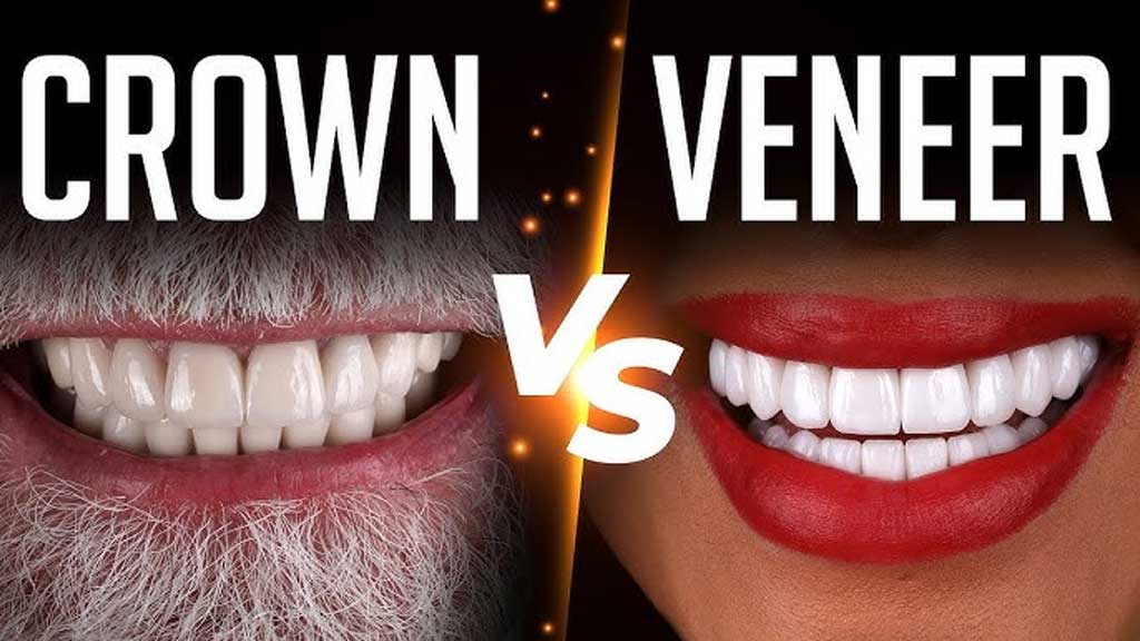 ایا لمینت همان روکش دندان است؟