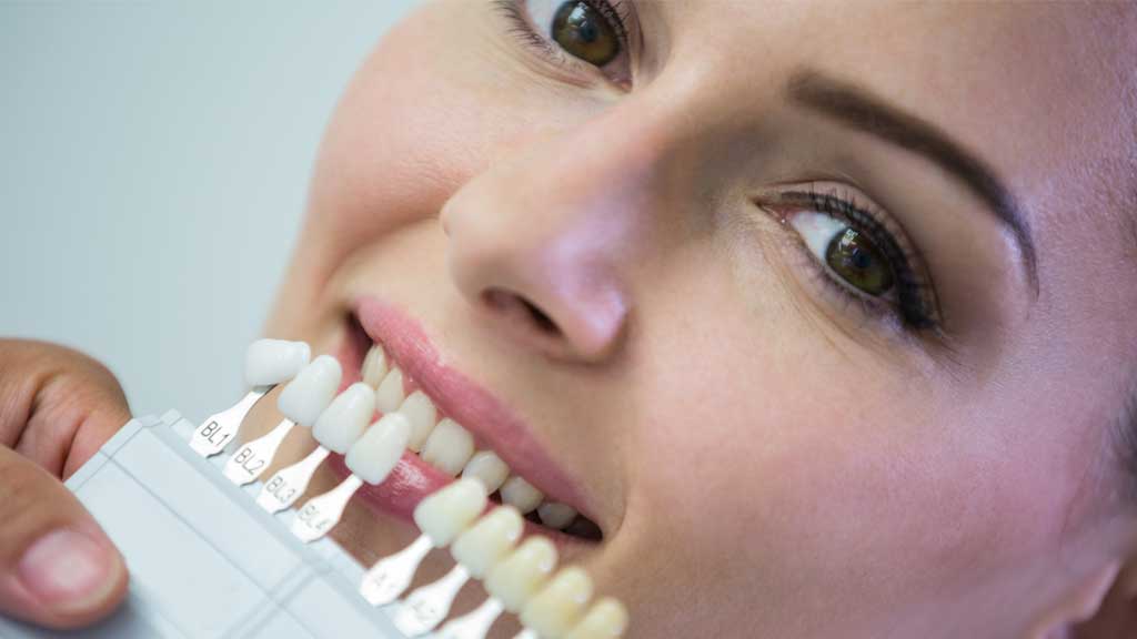 لمینت روی روکش دندان