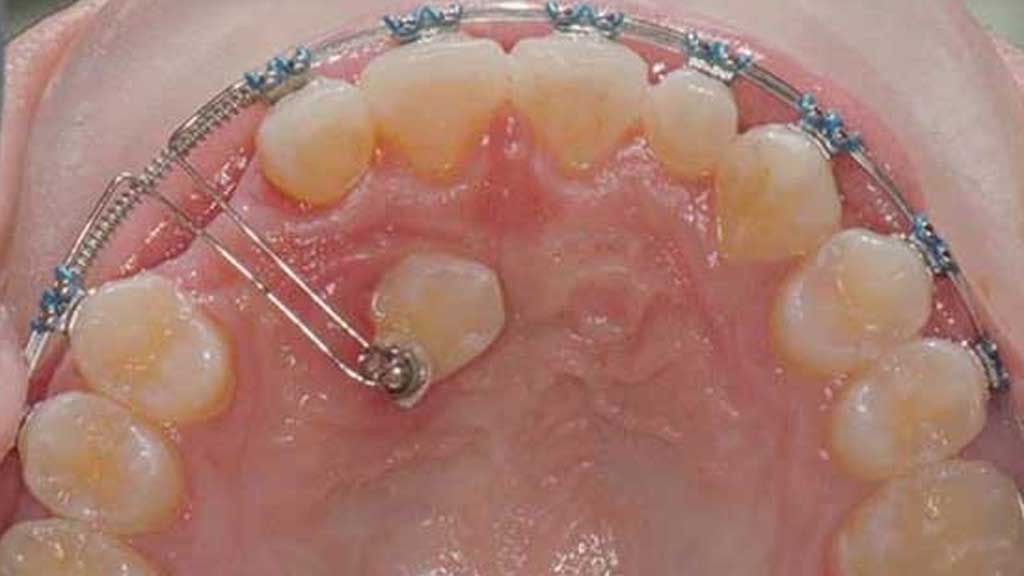 ارتودنسی فقط برای یک دندان