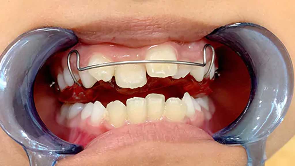 ارتودنسی تک دندان جلو