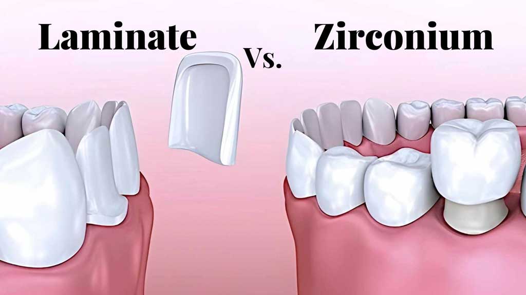 فرق لمینت با روکش زیرکونیا