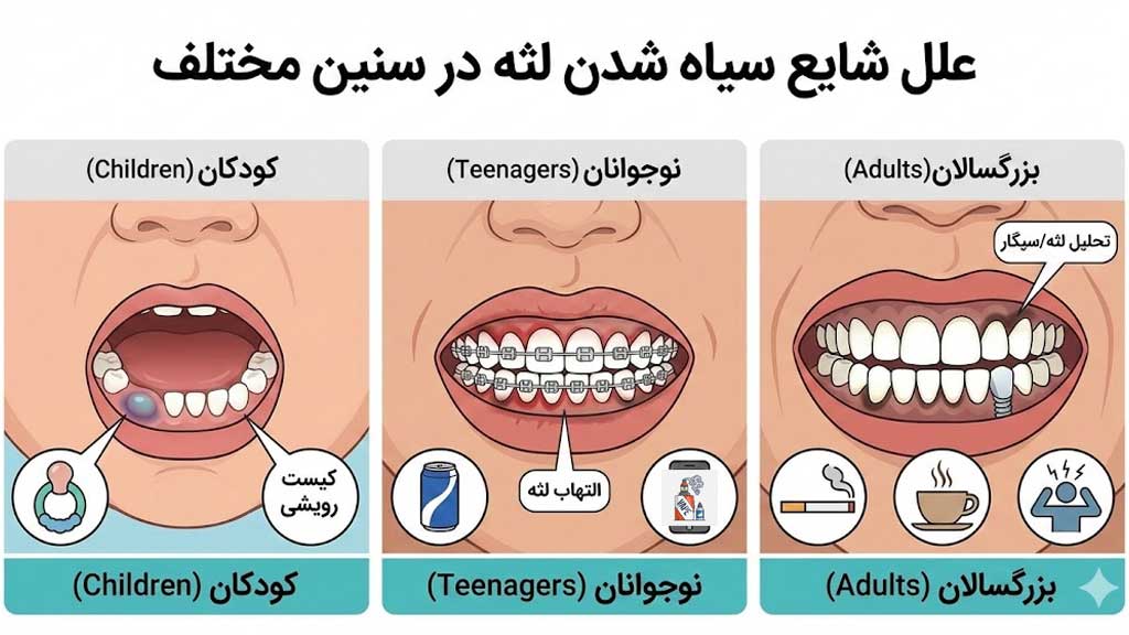 سیاهی لثه برای چیست؟ آیا خطرناک است؟