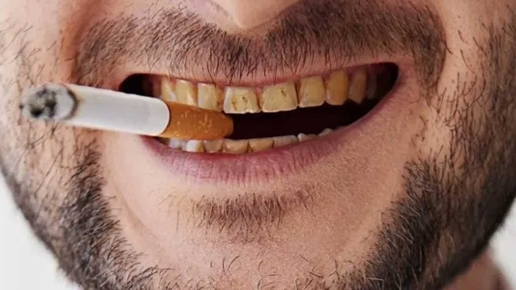 چگونگی تاثیر سیگار بر لمینت دندان