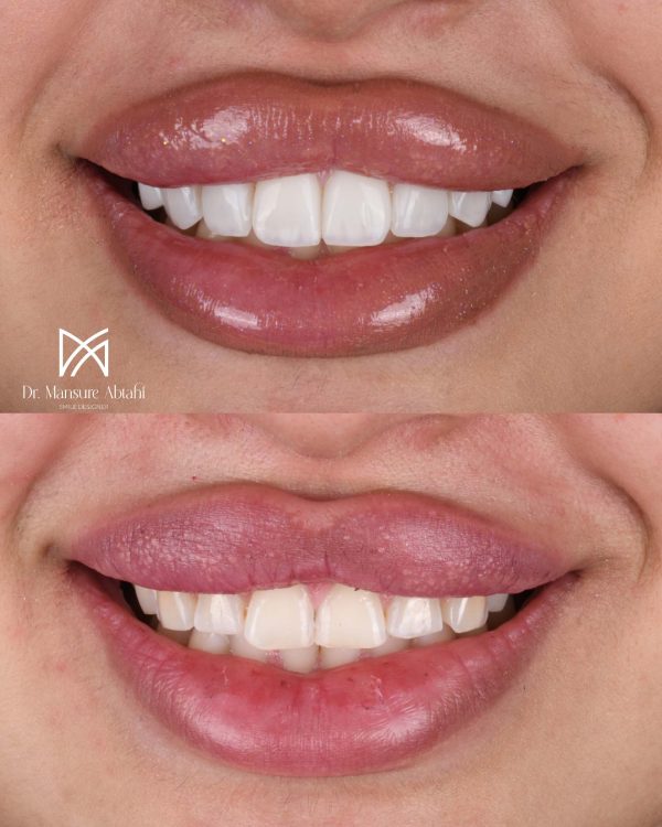 درمان ونیر کامپوزیت در اصفهان | دکتر منصوره سادات ابطحی