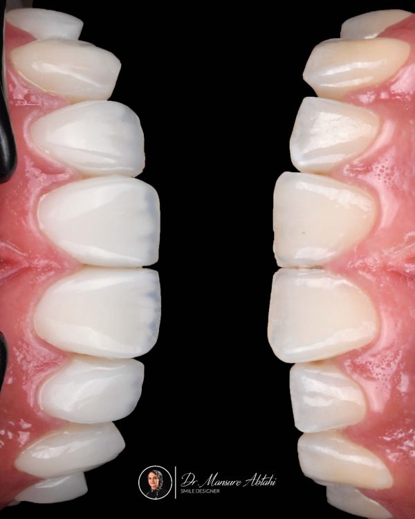 درمان ونیر کامپوزیت در اصفهان | دکتر منصوره سادات ابطحی