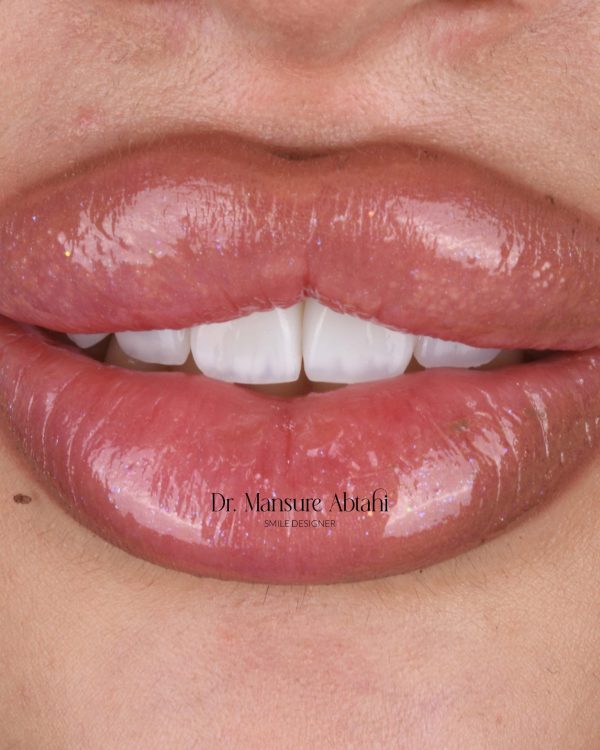 درمان ونیر کامپوزیت در اصفهان | دکتر منصوره سادات ابطحی