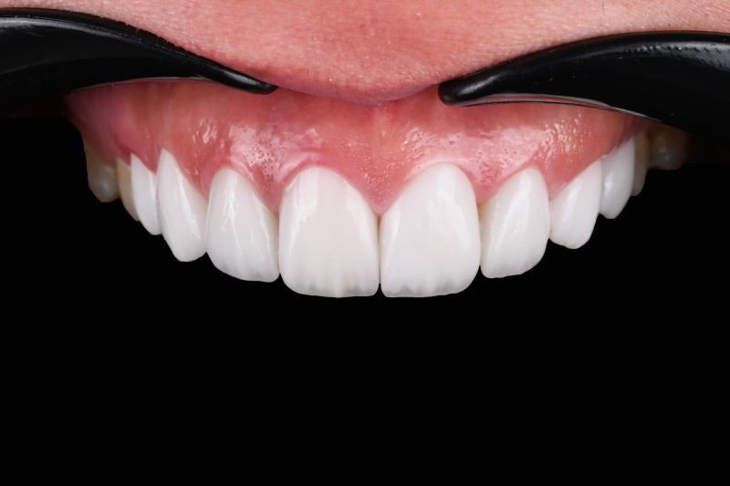 لمینیت سرامیکی در سپاهانشهر اصفهان