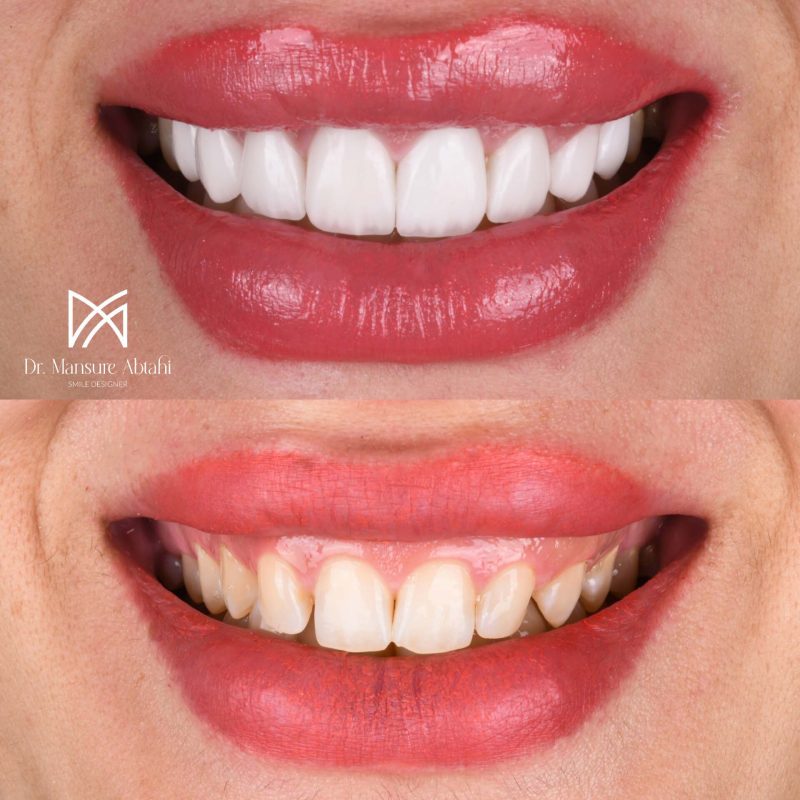 لمینیت سرامیکی در سپاهانشهر اصفهان