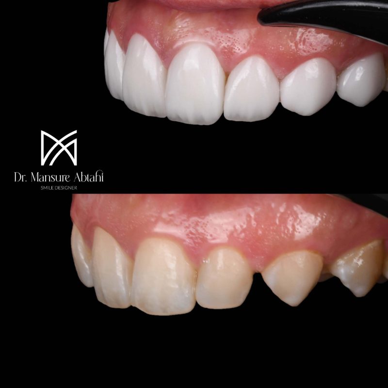 لمینیت سرامیکی در سپاهانشهر اصفهان