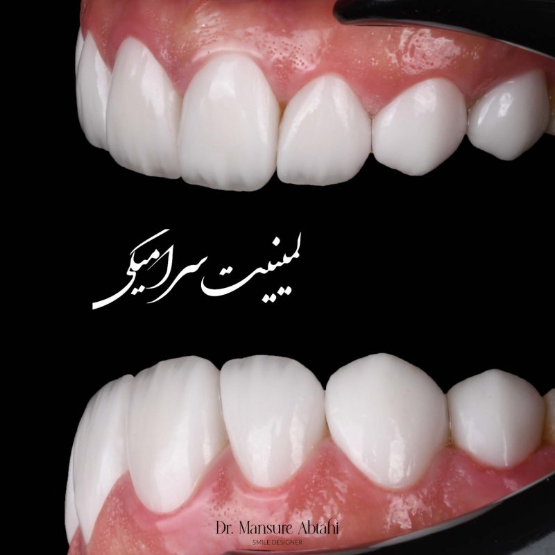 لمینیت سرامیکی در سپاهانشهر اصفهان