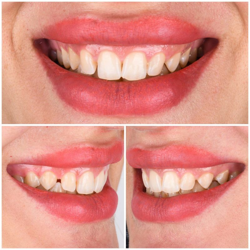 لمینیت سرامیکی در سپاهانشهر اصفهان