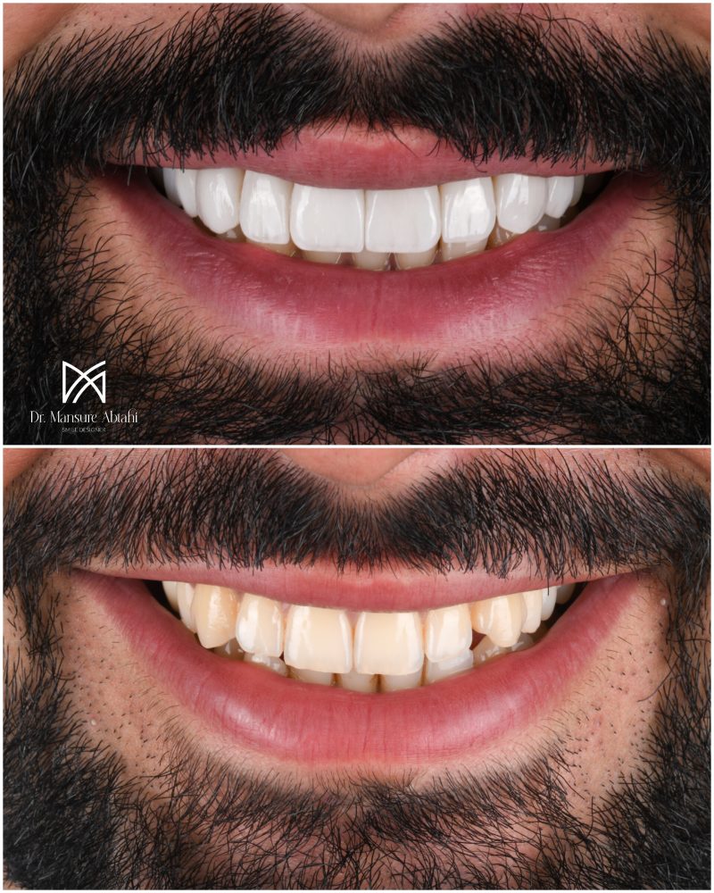 نمونه درمان لمینیت سرامیکی در اصفهان دکتر منصوره سادات ابطحی