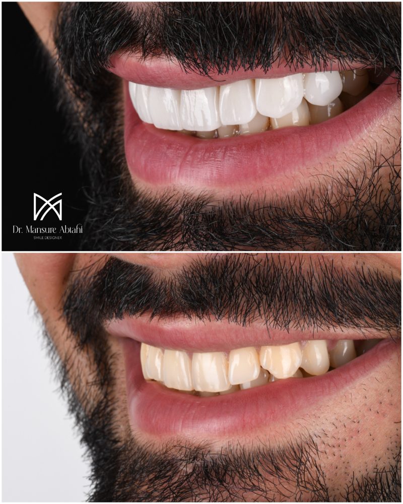 نمونه درمان لمینیت سرامیکی در اصفهان دکتر منصوره سادات ابطحی